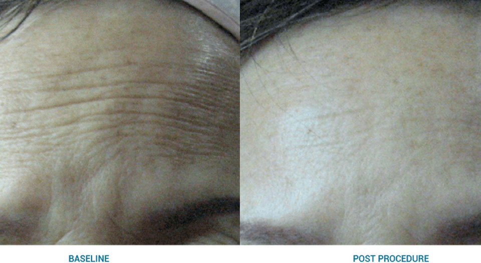 Before and after Ultraformer Ⅲ on the forehead