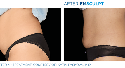 Before and after EmSculpt treatment on female stomach
