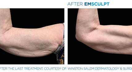 Before and after EmSculpt treatment on arms