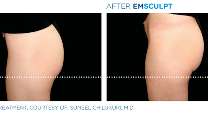Before and after EmSculpt treatment on buttocks