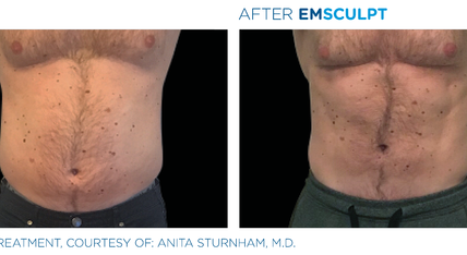 Before and after EmSculpt treatment on male stomach