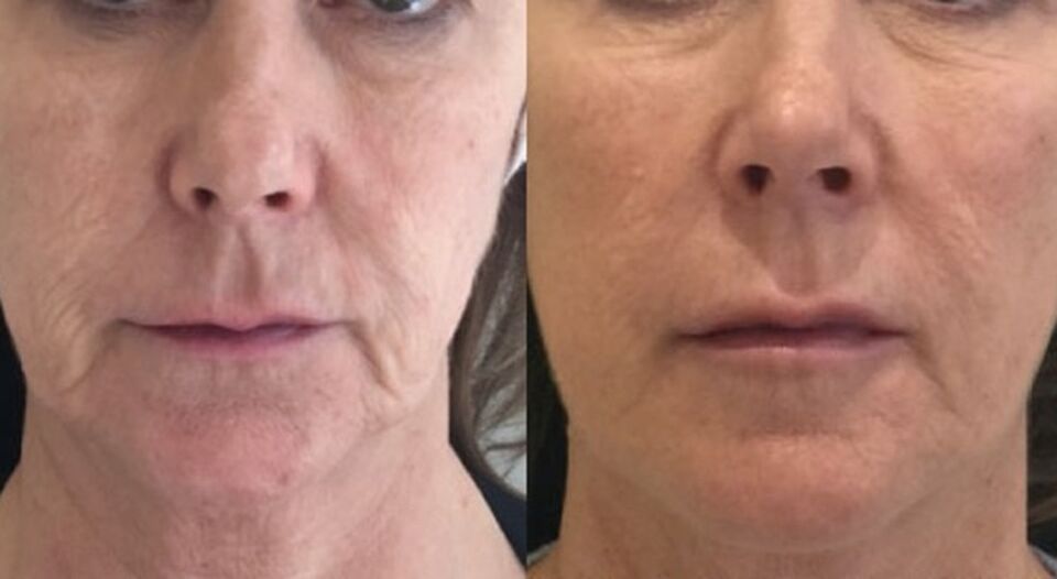 Before and after a Profhilo treatment on the face