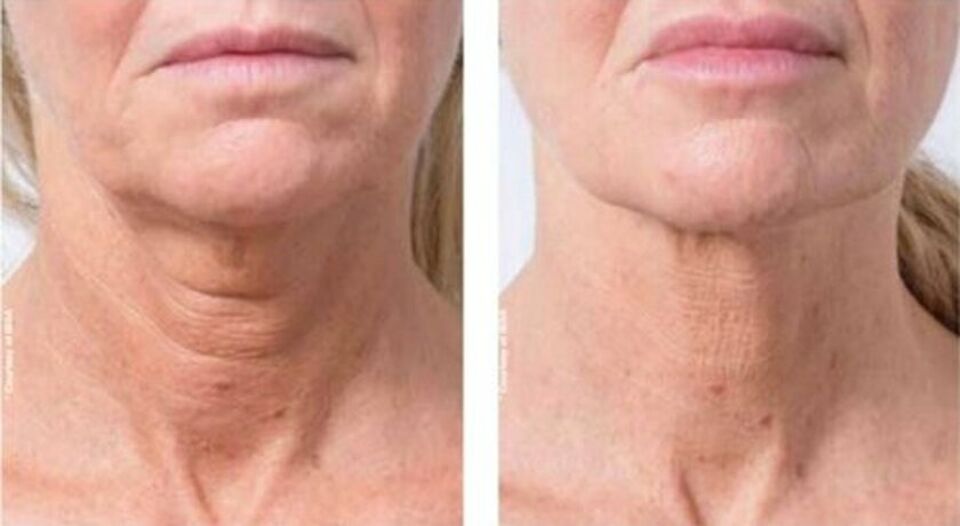 Before and after a Profhilo treatment on the neck